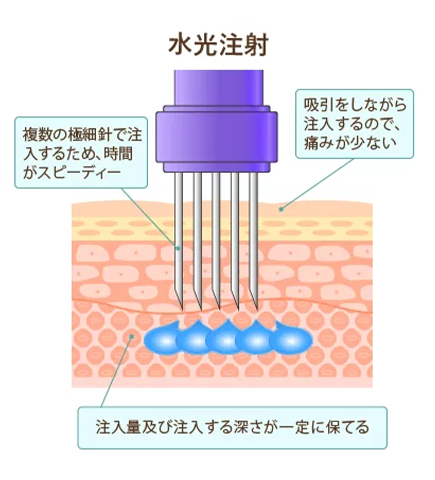 水光注射イメージ図